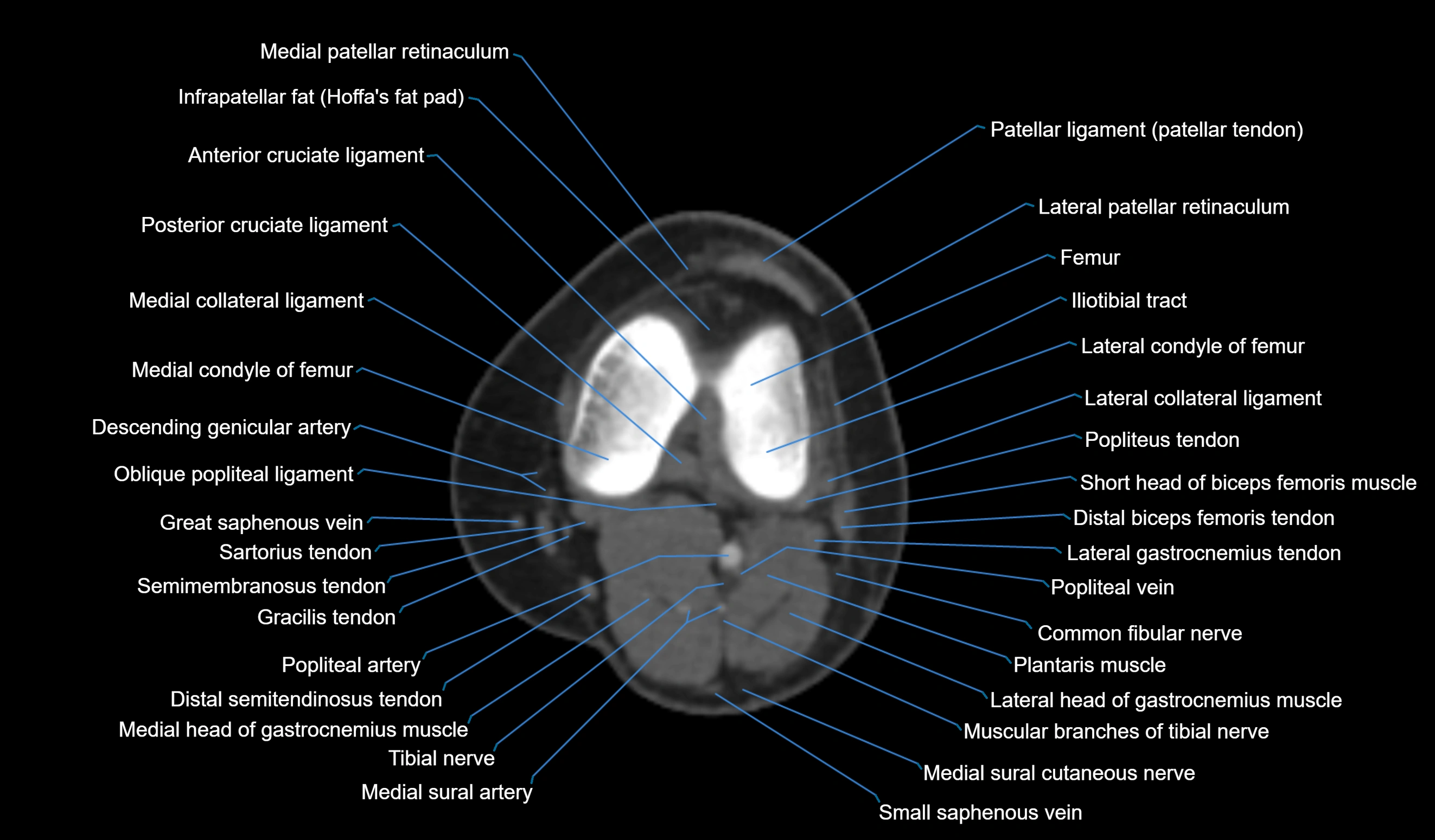 CT knee axial cross sectional anatomy labelled image-00034.webp